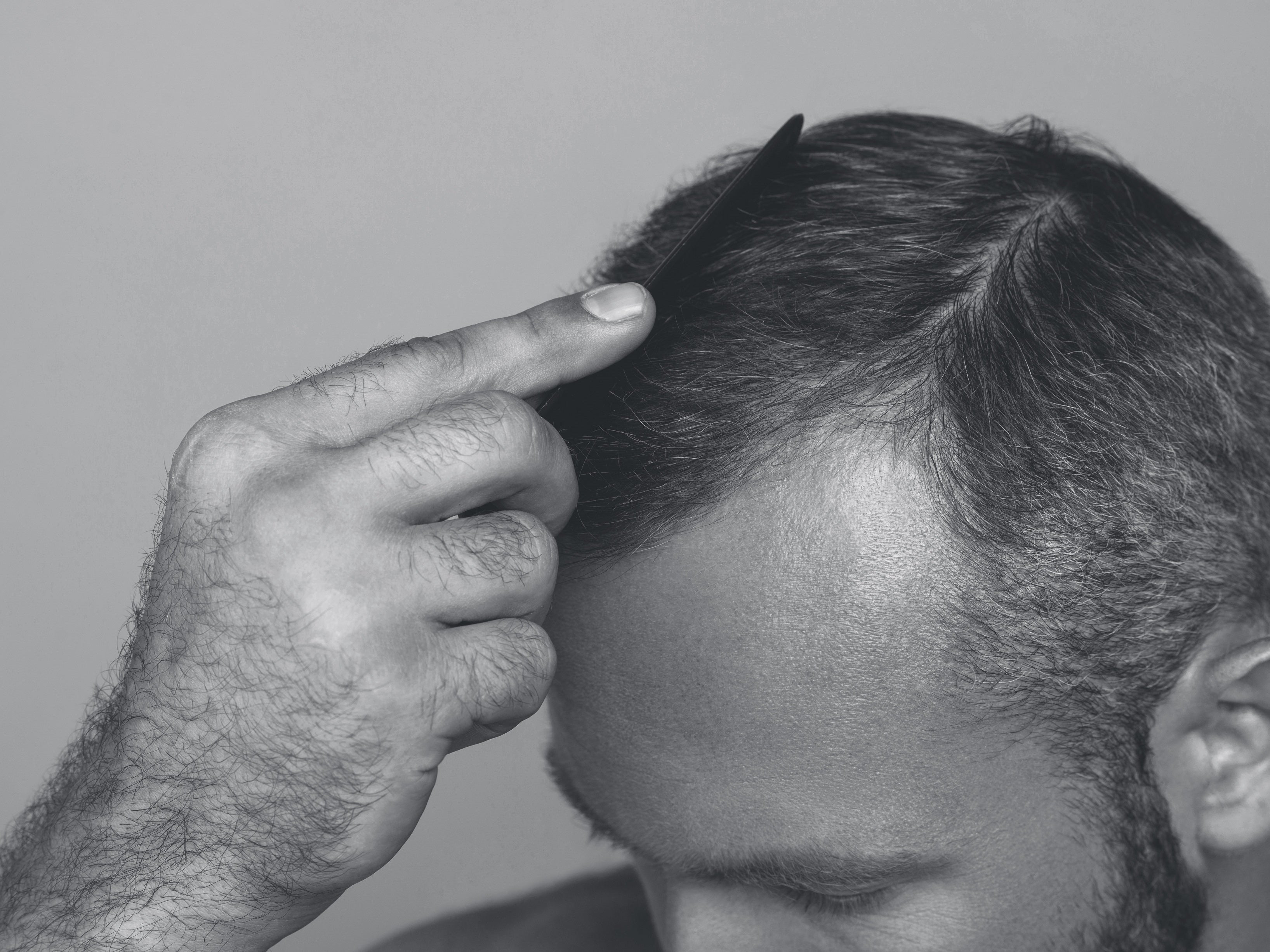 What causes hair loss in men?